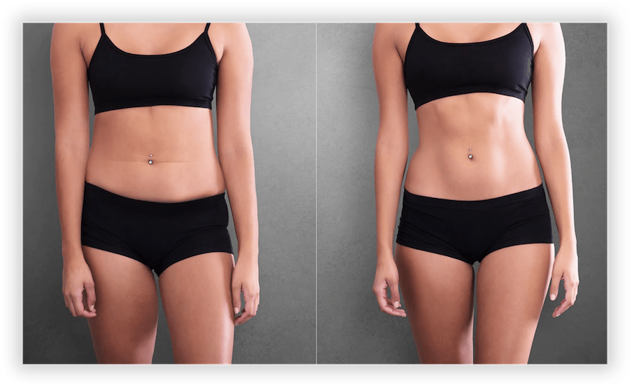 Body Contouring Before & After Pictures in Toronto & Mississauga Lip